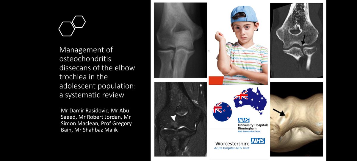 SpOrthopod's tweet image. Read our multicentre review &amp;amp; guidance on management of #elbow trochlea OCD in current issue of @ShoulderElbowJ. A rare pathology with little info in literature.

Presented @bessconference June 2021 

doi.org/10.1177%2F1758…

#orthotwitter #Orthopaedics @WorcsAcuteNHS @uhbtrust