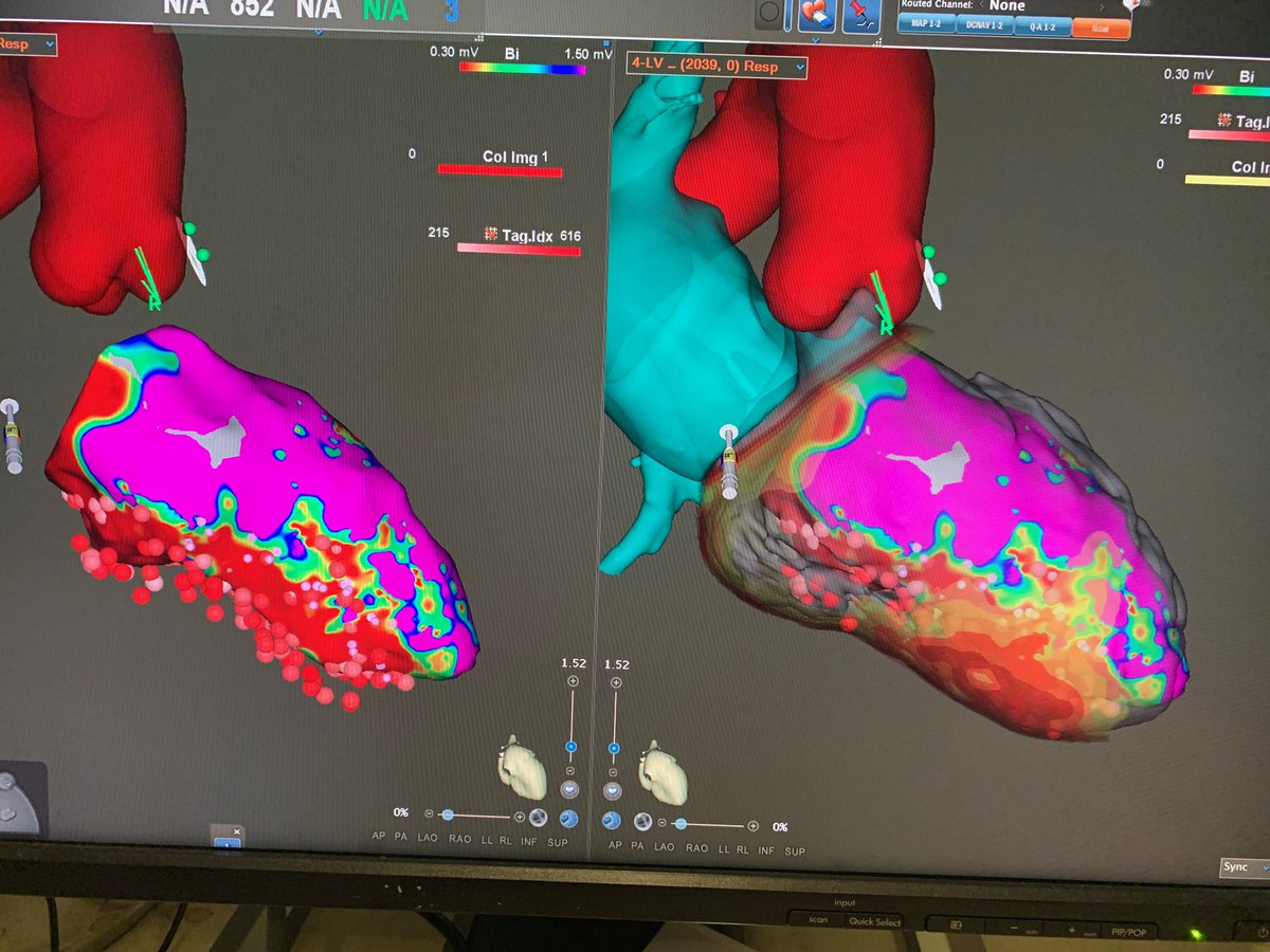 Ischemic VT from yesterday with the help of <a href="/inheartmedical/">inHEART</a> CT scan clearly delineating channels within the large inferolateral scar to target.  Mapping by the great <a href="/EP_JB13/">John Burke</a> @BiosenseWebster