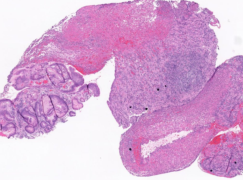 KevanSalimian's tweet photo. Adult patient with colon cancer complaining of new onset nausea and abdominal pain. EGD shows severe ulceration of antrum and duodenum. Biopsy from antrum. Your diagnosis?? #PathTwitter #GIPath #MedEd #GITwitter https://t.co/5IVwuBP49j