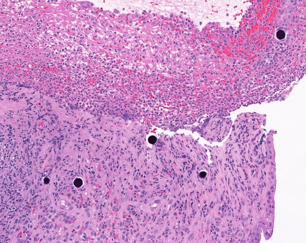 KevanSalimian's tweet photo. Adult patient with colon cancer complaining of new onset nausea and abdominal pain. EGD shows severe ulceration of antrum and duodenum. Biopsy from antrum. Your diagnosis?? #PathTwitter #GIPath #MedEd #GITwitter https://t.co/5IVwuBP49j