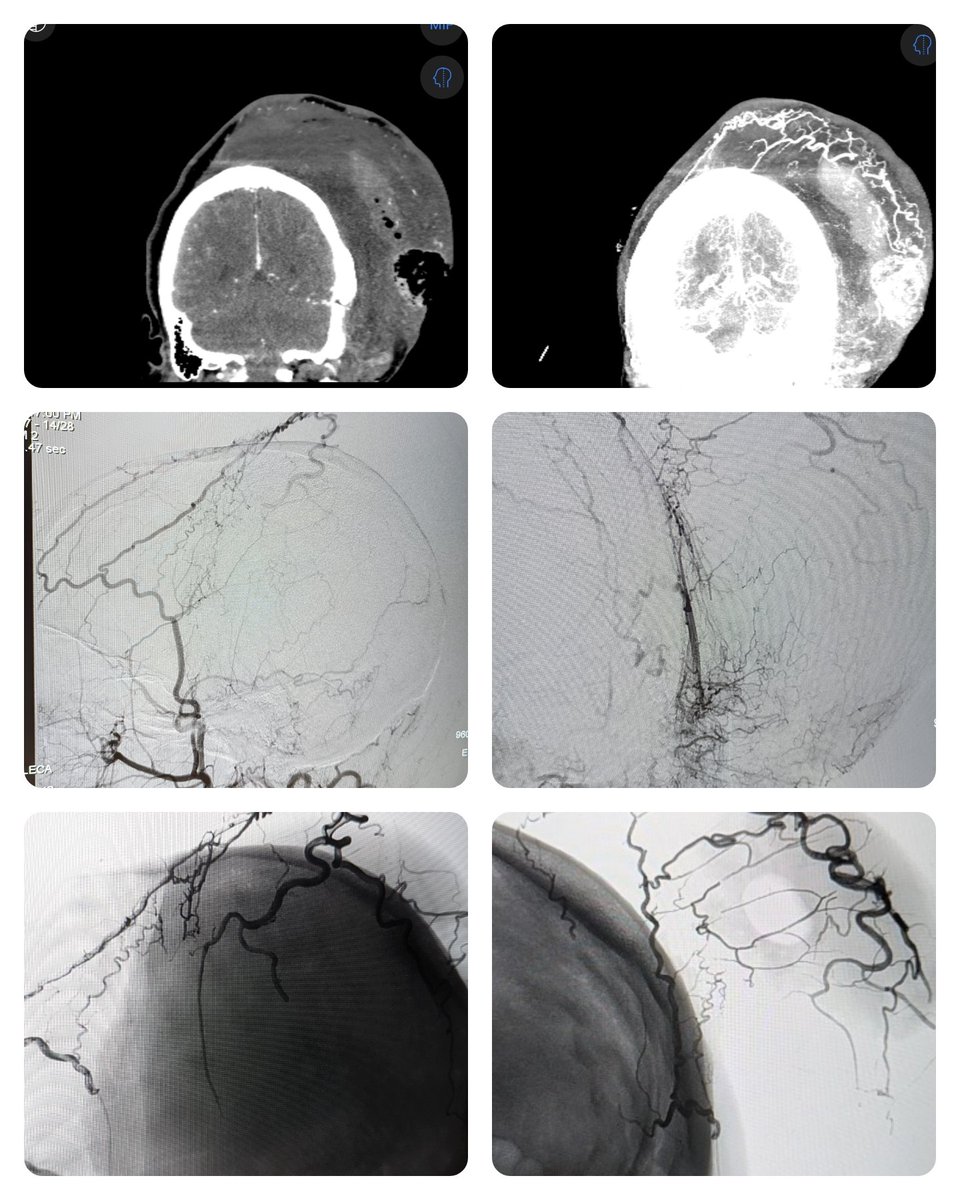 27 yo with neurofibromatosis that's been debulked several times. Involved in a trauma during which she has an intratumor hemorrhage. She got a bedside I&amp;D with 500cc of blood evacuated... and then it wouldn't stop bleeding. 

So we embolized it.