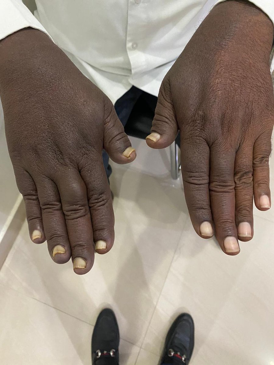 What are the abnormal findings?
Possible diagnosis?
(Pics courtesy: Dr K K Jain)
#MedTwitter #doctor #spotthediagnosis #internalmedicine #challengingcases
