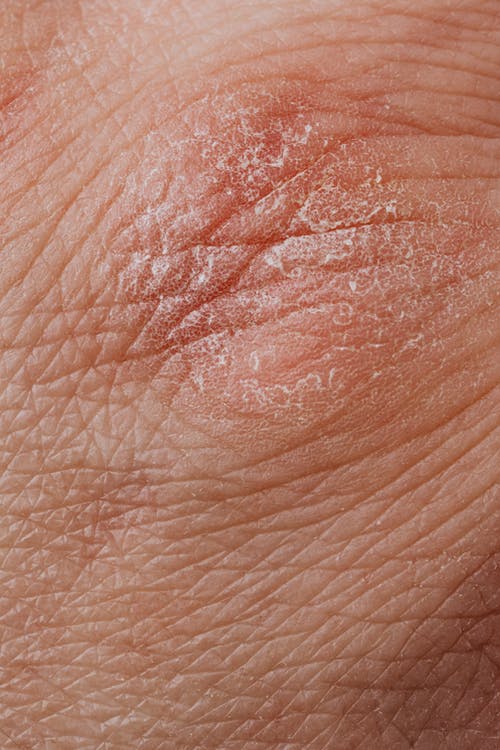 StocktonDerm's tweet photo. Eczema is a common skin that can cause flaky, itchy, and dry patches of skin. There are some skin conditions that may resemble eczema, so you should know the difference! Here's what you need to know: 

https://t.co/3ePI9iP7WO  

#SkinConditions https://t.co/kYX3bbUvF5