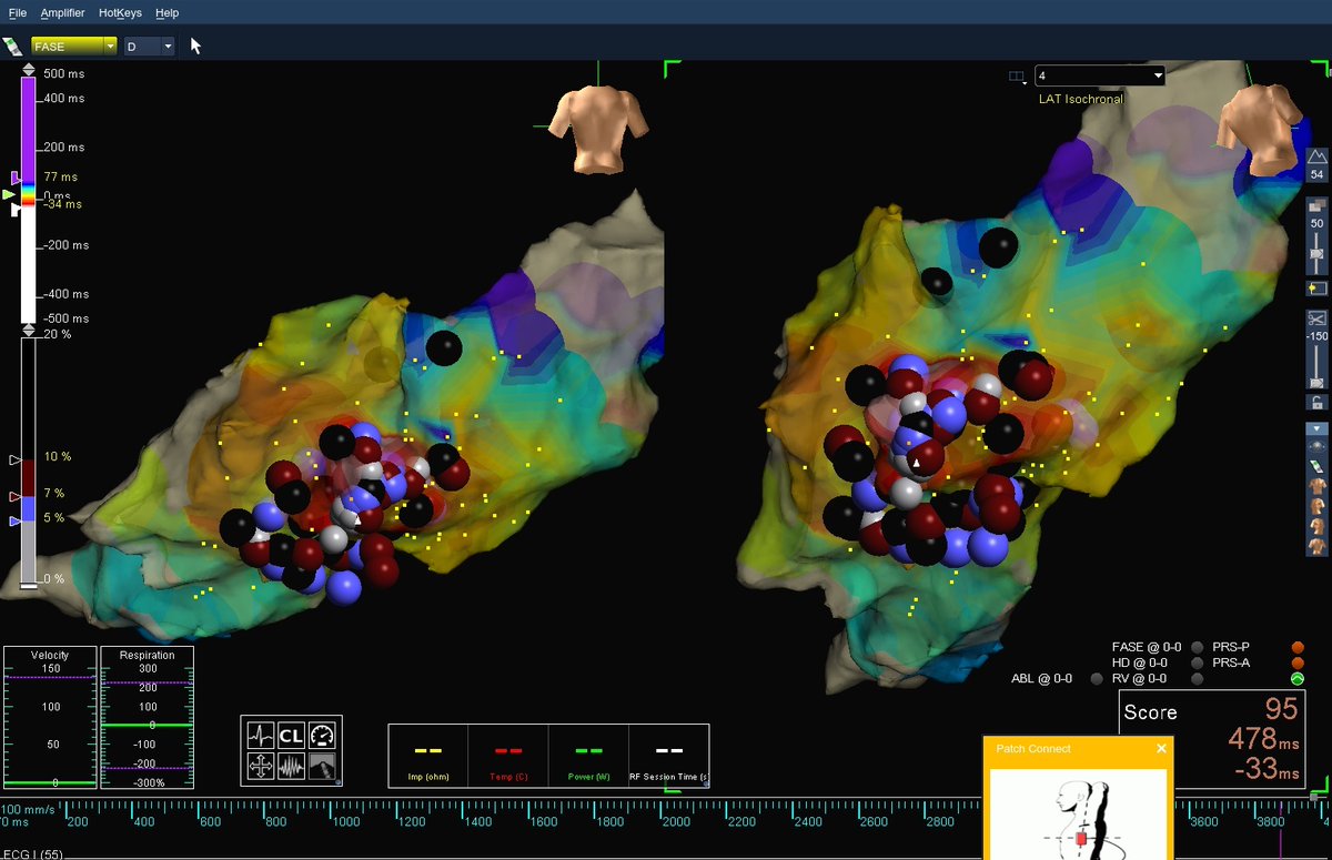 M.Serdar Kuyumcu (@mserdarkuyumcu) on Twitter photo Posteroseptal PVC causing cardiomyopathy (EF 35%)
<a href="/drtopaloglu/">Prof. Dr. Serkan Topaloğlu</a> <a href="/DursunAras2/">Dursun Aras, Professor</a> <a href="/prof_serkan_cay/">Prof Dr Serkan Cay</a> <a href="/drfiratozcan/">Fırat Özcan</a> <a href="/ozcanozeke/">Özcan Özeke</a> <a href="/dr_fatihucar/">Fatih Mehmet UÇAR</a> <a href="/BURAKCMD2/">Cengiz Burak, MD, DRCPSC</a> <a href="/gokselcinier/">Göksel Çinier</a> <a href="/ayhankup/">ayhankup</a> <a href="/mertilkerh/">Mert İlker Hayıroğlu</a> @MD_cardiology <a href="/SebahatUlusan/">Sebahat Ulusan, MD 👩🏼⚕️</a> <a href="/TKDsosyal/">Turkish Society of Cardiology</a> <a href="/ACH_epteam/">Yuksek Ihtisas Arrhythmia- Ankara City Hospital</a> Posteroseptal PVC causing cardiomyopathy (EF 35%)
<a href="/drtopaloglu/">Prof. Dr. Serkan Topaloğlu</a> <a href="/DursunAras2/">Dursun Aras, Professor</a> <a href="/prof_serkan_cay/">Prof Dr Serkan Cay</a> <a href="/drfiratozcan/">Fırat Özcan</a> <a href="/ozcanozeke/">Özcan Özeke</a> <a href="/dr_fatihucar/">Fatih Mehmet UÇAR</a> <a href="/BURAKCMD2/">Cengiz Burak, MD, DRCPSC</a> <a href="/gokselcinier/">Göksel Çinier</a> <a href="/ayhankup/">ayhankup</a> <a href="/mertilkerh/">Mert İlker Hayıroğlu</a> @MD_cardiology <a href="/SebahatUlusan/">Sebahat Ulusan, MD 👩🏼⚕️</a> <a href="/TKDsosyal/">Turkish Society of Cardiology</a> <a href="/ACH_epteam/">Yuksek Ihtisas Arrhythmia- Ankara City Hospital</a>
