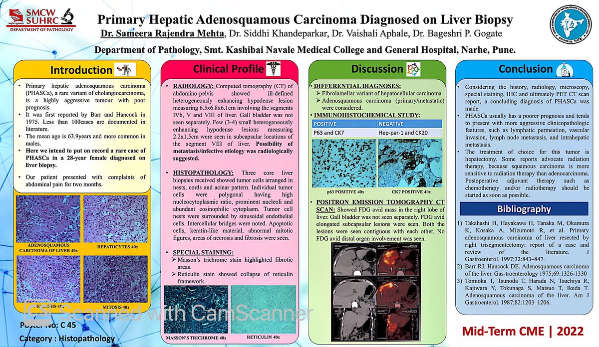 MehtaSameera's tweet photo. Residency Bucket List!
Poster presentation done right!β
β
Primary Hepatic Adenosquamous Carcinoma Diagnosed on Liver Biopsy
#Liver #Carcinoma #Biopsy #Histopathology #Immunohistochemistry #Conference #Poster #LoveForPath #TweetPath https://t.co/HA6UxciOzs
