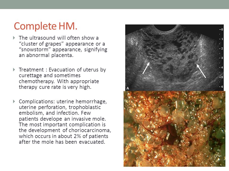 Sthanu on Twitter: "In complete molar pregnancy, one typically sees a
