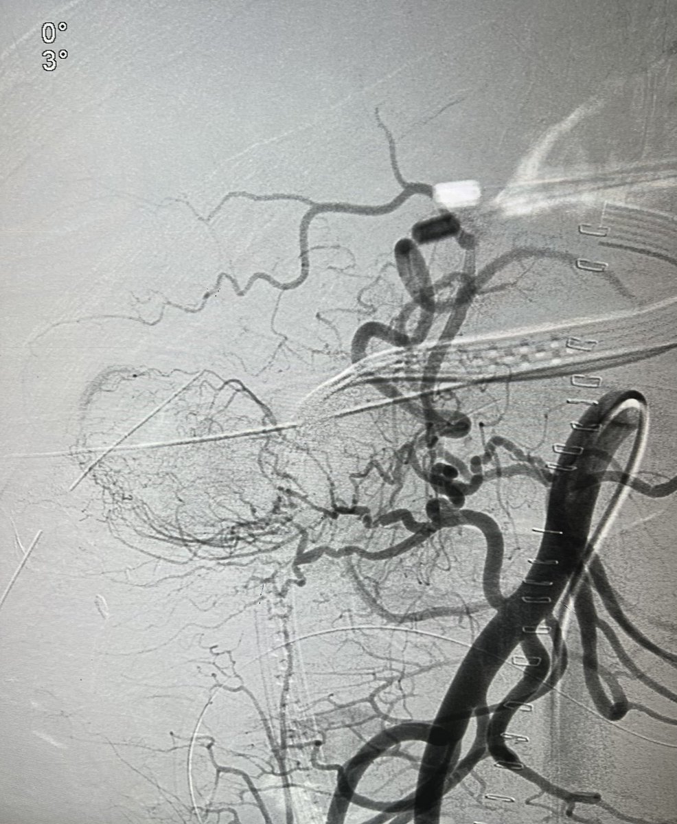 Dr Ajit Yadav (@drajityadav) on Twitter photo Upper GI 🩸
Pancreatitis
Pseudoaneurysm from duodenal branch
Superslective cannulation failed due to spasm/dissection
Percut GLUE injection done
<a href="/ELEC_radiology/">European Liquid Embolic Course</a> <a href="/RajNarayanan67/">Raj Narayanan</a> <a href="/drgauravgangwni/">Dr. Gaurav Gangwani (Interventional Radiologist)</a> <a href="/ISVIRIndia/">ISVIR India</a> @IR_juniors <a href="/SIRRFS/">SIR RFS</a> <a href="/No_cut_surgery/">IIR IRad indore</a> <a href="/paragpatel_IR/">Parag Patel</a> <a href="/thegestgroup/">GEST -Global Embolization Symposium & Technologies</a> Upper GI 🩸
Pancreatitis
Pseudoaneurysm from duodenal branch
Superslective cannulation failed due to spasm/dissection
Percut GLUE injection done
<a href="/ELEC_radiology/">European Liquid Embolic Course</a> <a href="/RajNarayanan67/">Raj Narayanan</a> <a href="/drgauravgangwni/">Dr. Gaurav Gangwani (Interventional Radiologist)</a> <a href="/ISVIRIndia/">ISVIR India</a> @IR_juniors <a href="/SIRRFS/">SIR RFS</a> <a href="/No_cut_surgery/">IIR IRad indore</a> <a href="/paragpatel_IR/">Parag Patel</a> <a href="/thegestgroup/">GEST -Global Embolization Symposium & Technologies</a>