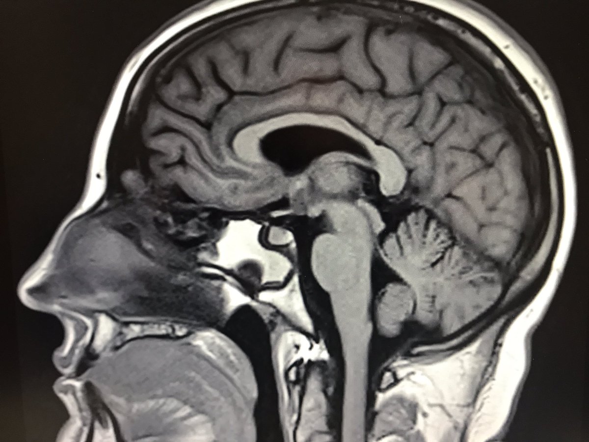 Esallee's tweet photo. #PhDupdate Quick share. Been MIA as I continue to battle sinonasal disease. Surgery booked for later this month. I refuse to let this stop me but right now I need to rest and focus on my health https://t.co/V5Xs16k3tH