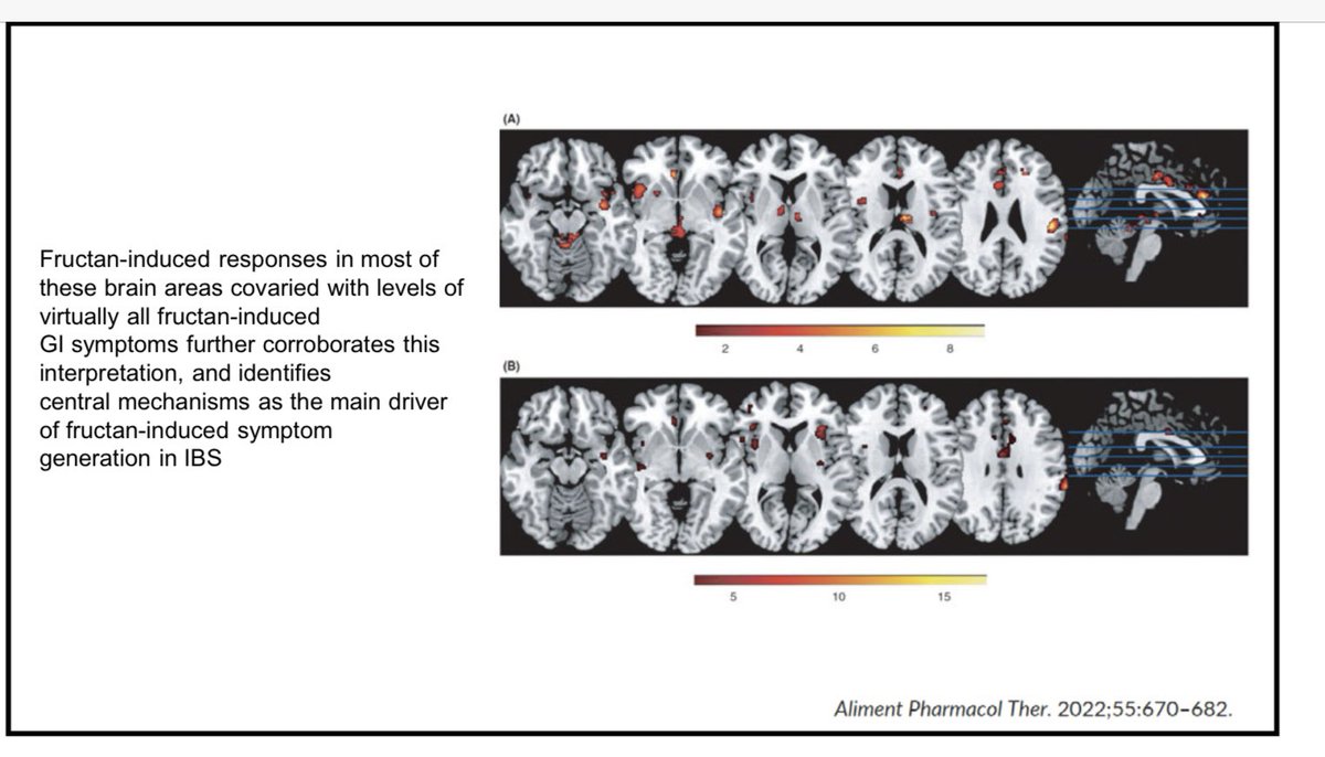 Proof that it is a disorder of gut-brain interaction…despite the same gut physiologic reaction to ingestion of fructans, the brains of pts with IBS literally processed that information differently on functional MRI! #ANMS2022 Dr Jose Garza <a href="/ANMSociety/">ANMS</a>