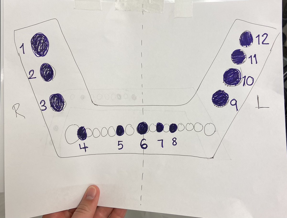 ewenn16's tweet image. Practical tip I’ve learned while on my 1st visiting rotation: hang a map in the OR of all the screws in the hardware you are removing. Simple way to ensure you don’t leave any screws behind without needing to continuously check the CT scan while operating.
