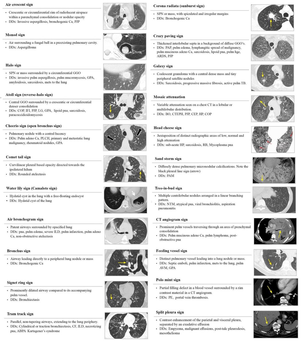 #Chest CT Signs in #Pulmonary Disease: A Pictorial Review <a href="/accpchest/">CHEST</a> h/t <a href="/Vilavaite/">María J. Díaz Candamio</a>
#ChestCT #radiology #pneumology #radiography #radiographystudent  #FOAMrad #radres #chest #radtwitter #MedTwitter #MedEd #Medstudenttwitter #INNOMed linkinghub.elsevier.com/retrieve/pii/S…