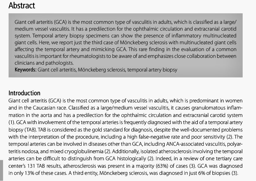 SixandLaura's tweet image. Mönckeberg sclerosis with giant cells as a masquerade
of giant cell arteritis

10/21/2020

#vasculitis #opthalmic #temporal #atherosclerosis #sclerosis #arteritis #multinucleated_giant_cells #rheumatology  
eurjrheumatol.org/en/monckeberg-…