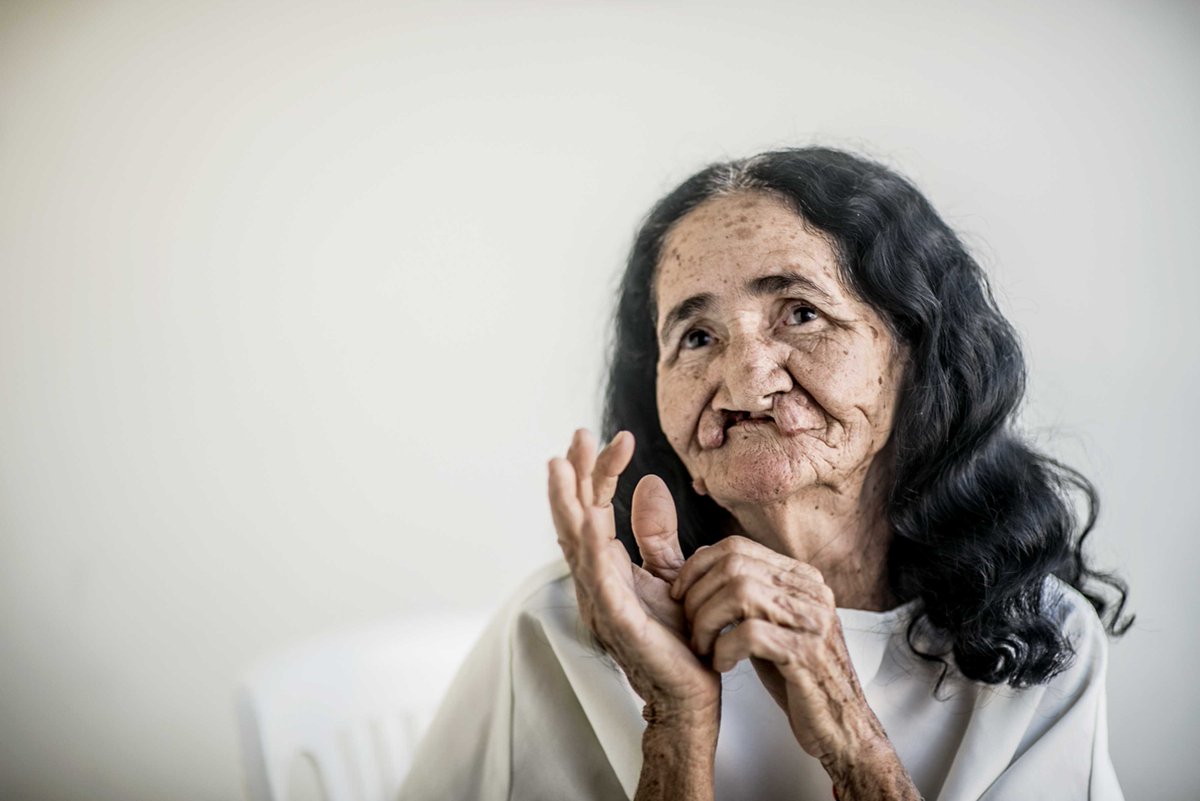 OpSmileSA's tweet photo. For 67 years Dona Maria lived with an unrepaired cleft lip and dreamt of one thing only. Though seen by many as a simple pleasure, what she wished for most was to wear lipstick.
After allowing her lip to properly heal she could finally live out her dream. #ASmileIs #cleft https://t.co/T0NW6yZ1A4