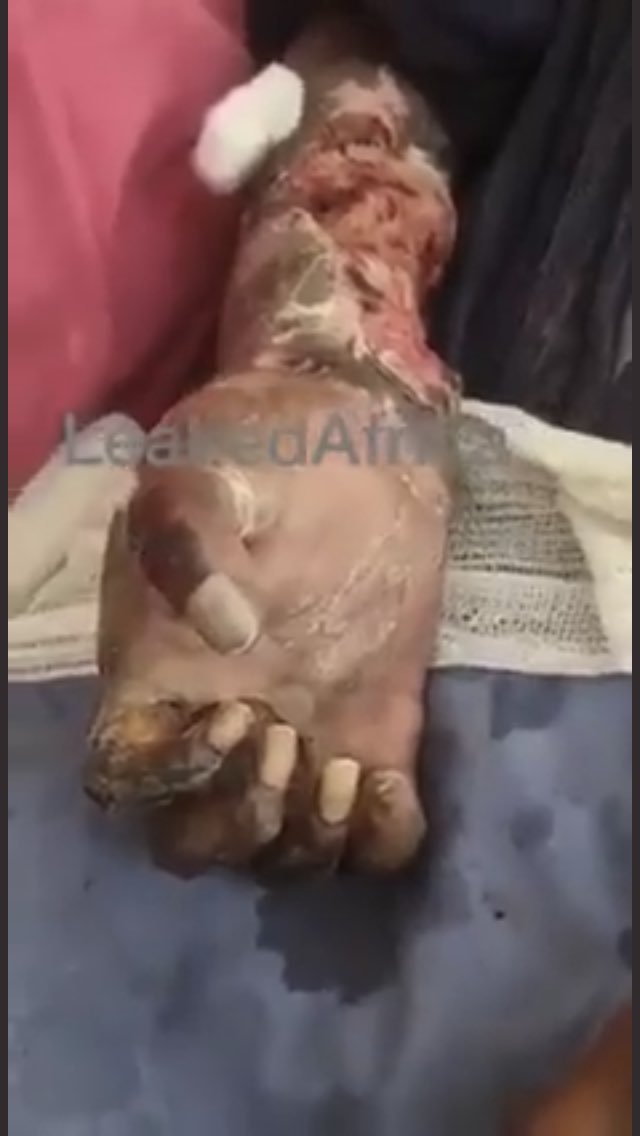 HumanRights112's tweet photo. @nickmangwana @edmnangagwa Stop scoring political points by being the judge and jury who is our heroโผ๏ธ
Address @MarryMubaiwa as she needs serious medical attention and skin graftingโญ๏ธ
#JusticeForMary #JusticeForSusanMutami #JusticeForNyatsime15 โผ๏ธ https://t.co/y4DQztLrzi