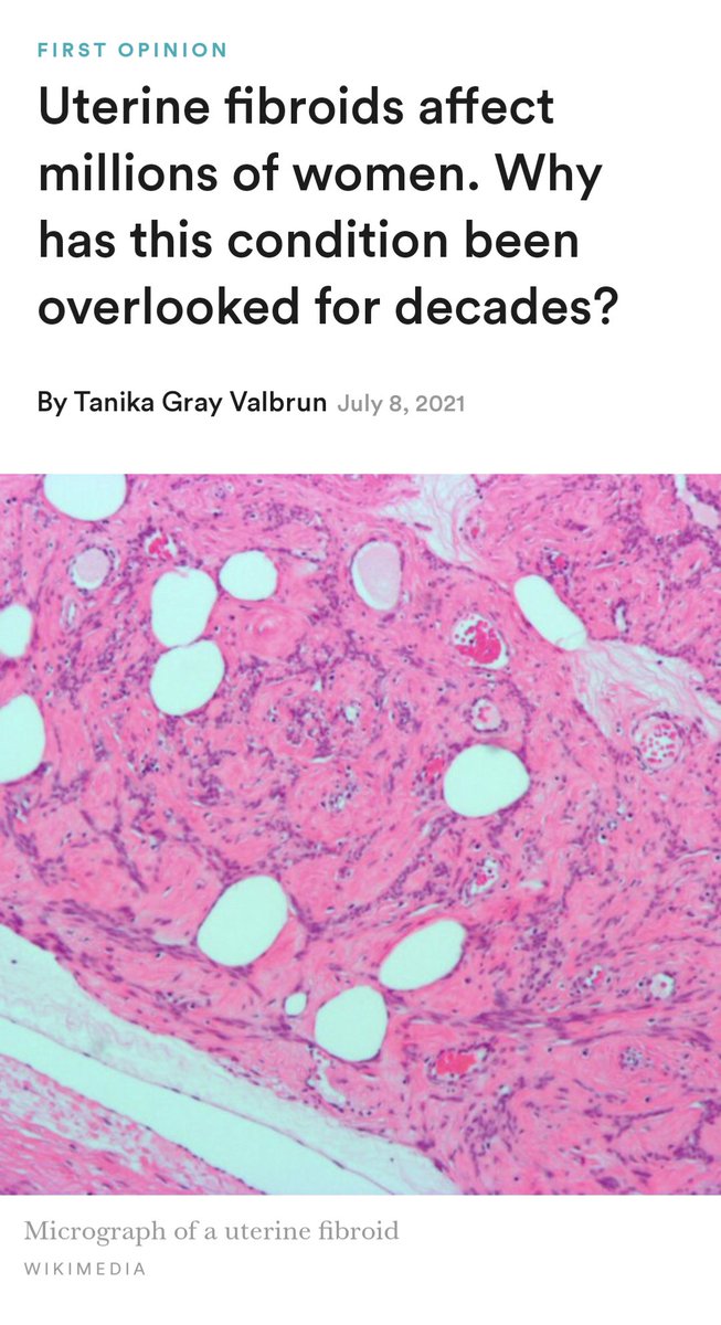 🤔 Wonder why? ♀️ "Fibroids received just $17M in (US) research funding from Nat'l Institutes of Health, putting it in the bottom 50 of almost 300 funded conditions, even though the direct &amp; indirect medical costs related to fibroids estimated $35B /yr."

statnews.com/2021/07/08/ute….