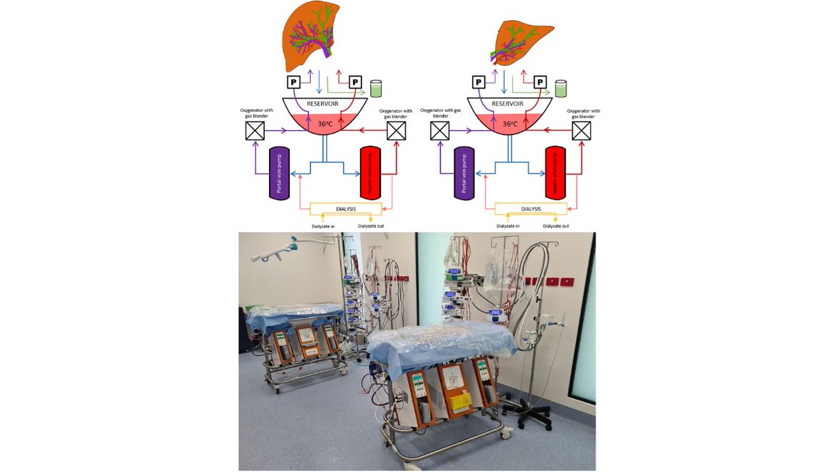 ArtifOrgans's tweet photo. Long-term #Normothermic #Perfusion of human #Livers for longer than 12 days👇
https://t.co/NbvwPrcUhc
@Rpahos_school🇦🇺| @Soon_lau @Carpul1 #ExSituMachinePerfusion #SplitLivers https://t.co/XZLKo4rZg1