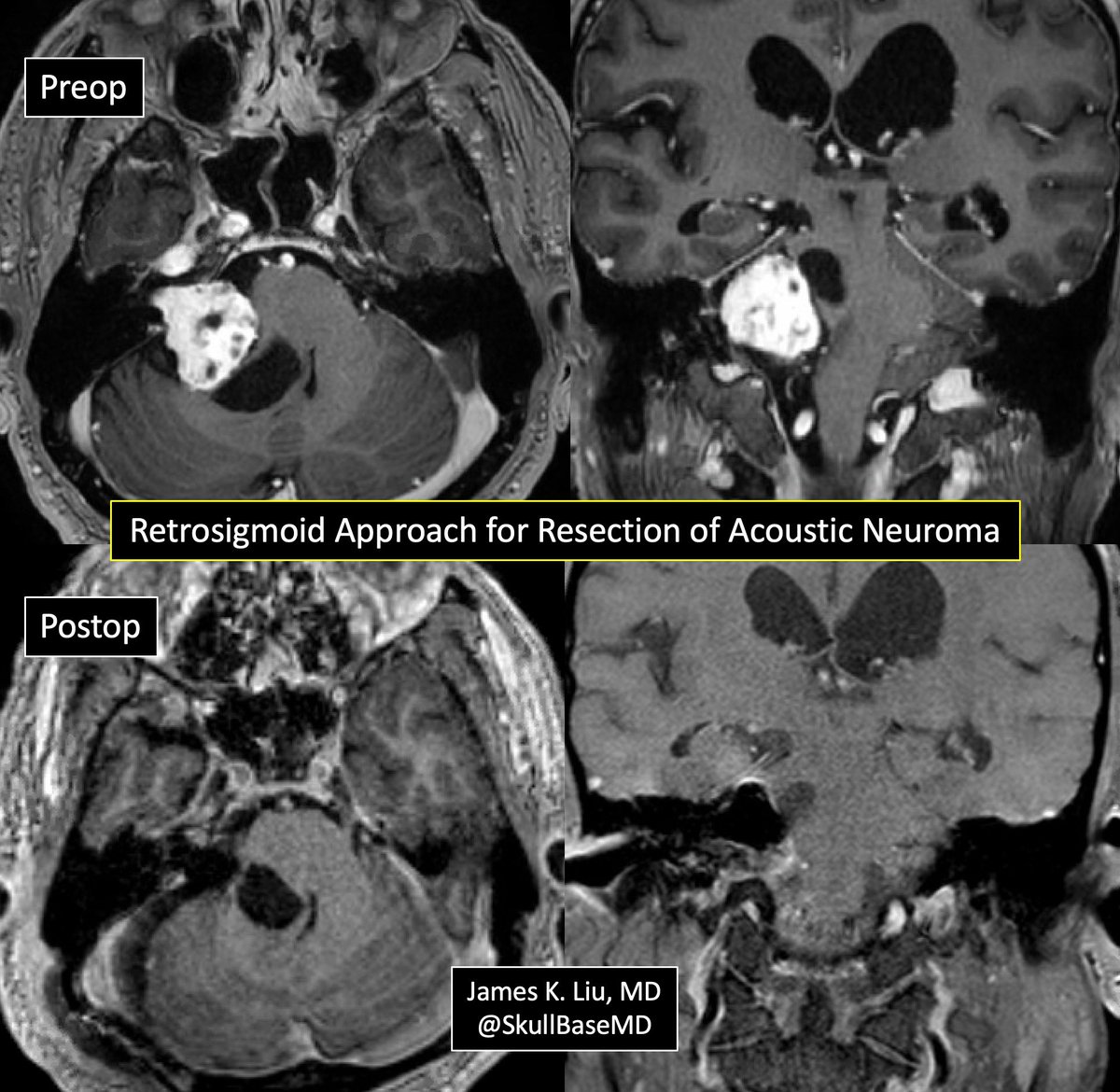 James K. Liu, MD tweet media