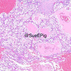 SueEPig's tweet photo. #twofer intermittent gross hematuria #radicalnephrectomy performed
☝🏼Red-orange to red-brown, focally cystic and hemorrhagic mass
✌🏼Tan-white, lobulated and friable mass, grossly granular and papillary within the collecting system 
#gupath #kidneycancer #pathtwitter https://t.co/eqsw6C1Uxd