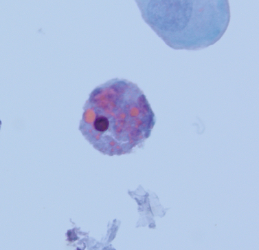megothelioma's tweet photo. These eosinophilic cytoplasmic inclusions, called Melamed-Wolinska bodies, are seen in degenerated urothelial cells.
#Cytopath #basicpath #Pathtwitter https://t.co/J0oFeXVjaS