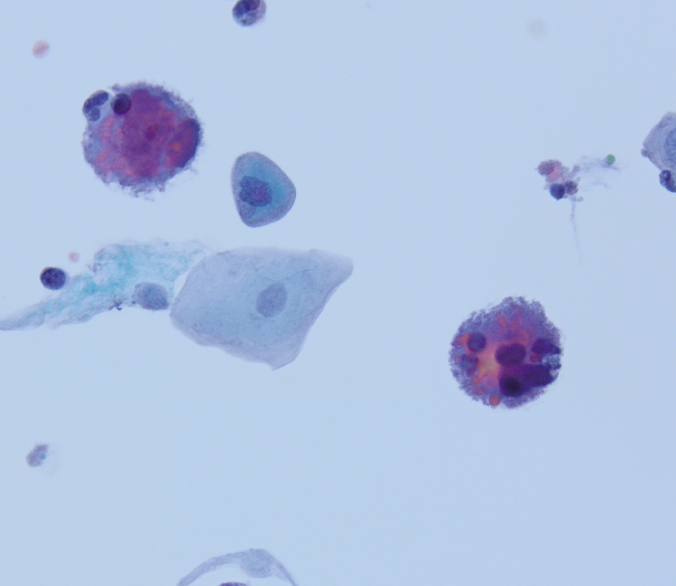 megothelioma's tweet photo. These eosinophilic cytoplasmic inclusions, called Melamed-Wolinska bodies, are seen in degenerated urothelial cells.
#Cytopath #basicpath #Pathtwitter https://t.co/J0oFeXVjaS