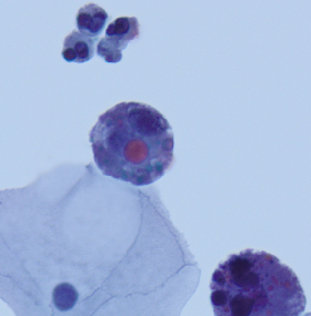 megothelioma's tweet photo. These eosinophilic cytoplasmic inclusions, called Melamed-Wolinska bodies, are seen in degenerated urothelial cells.
#Cytopath #basicpath #Pathtwitter https://t.co/J0oFeXVjaS