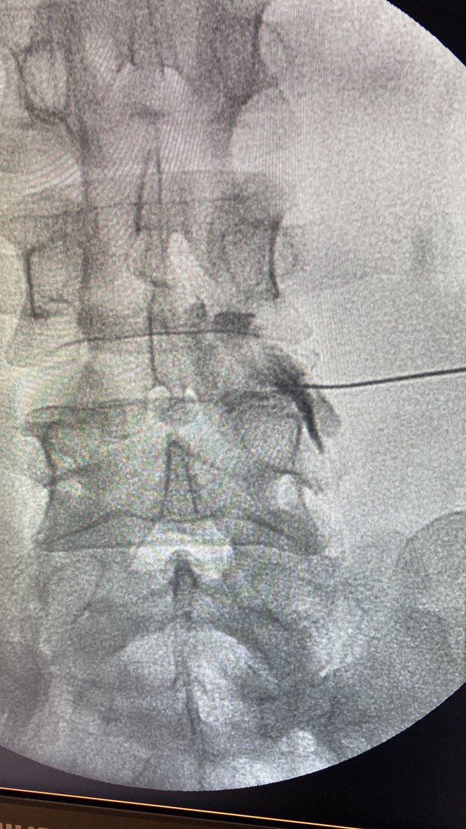 spineinjections's tweet photo. Right L3 infraneural ESI for subarticular and foraminal stenosis 
We will cover that topic at the Spine Needle Club https://t.co/9zdbs7aYz4