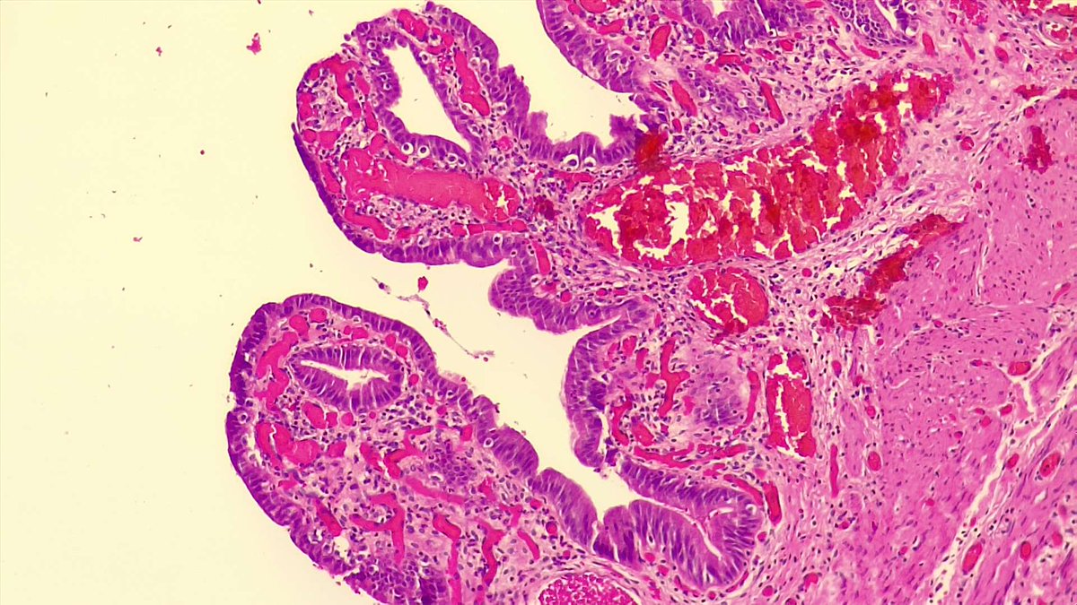 BuddingLiska's tweet photo. An incidental finding made by @christiestwit and @ChingLi31549786 😊 An ulcer was noted upon the gallbladder during a laparotomy for stab abdomen. The gallbladder was removed and here is the guilty culprit... What eagle-eyes we have in our department 🦅 https://t.co/vSJq1cj3fn