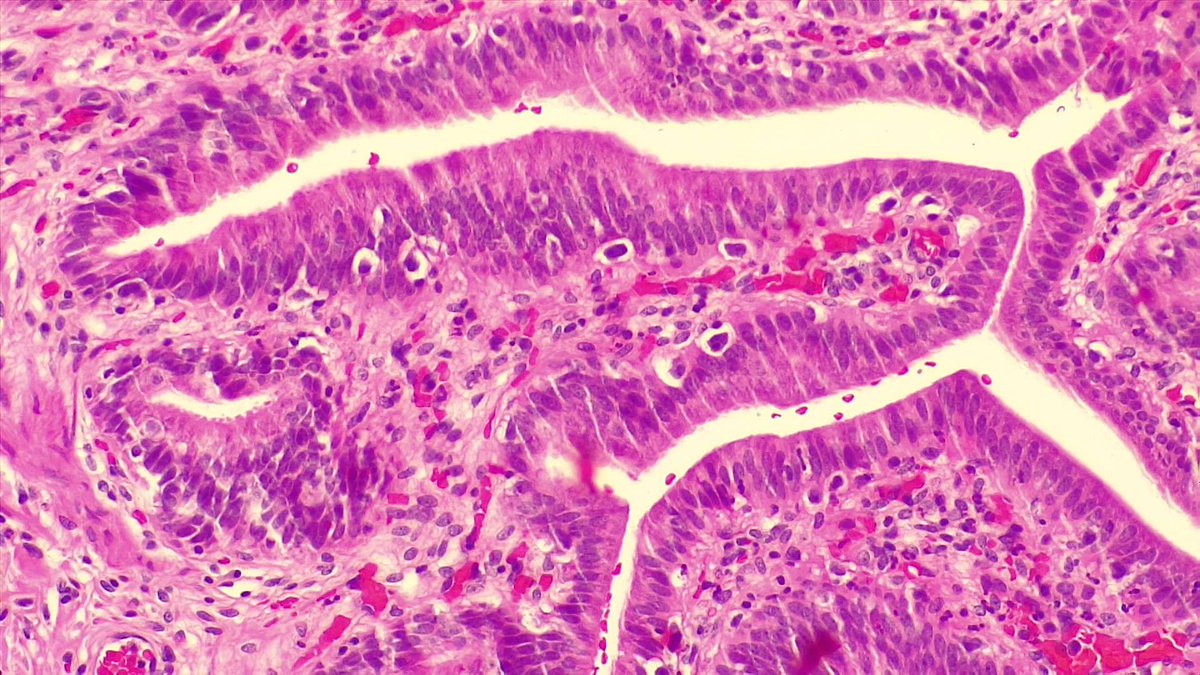 BuddingLiska's tweet photo. An incidental finding made by @christiestwit and @ChingLi31549786 😊 An ulcer was noted upon the gallbladder during a laparotomy for stab abdomen. The gallbladder was removed and here is the guilty culprit... What eagle-eyes we have in our department 🦅 https://t.co/vSJq1cj3fn