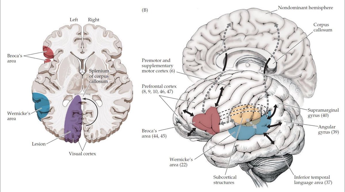 chrost_hugo's tweet image. Aphasia is an inability to comprehend or formulate language because of damage to specific brain regions listed below

#neuroscience #neurotwitter #neurology #science #sciencetwitter #medtwitter #Bioinformatics #biochemistry #biotechnology #anatomy #neuroanatomy