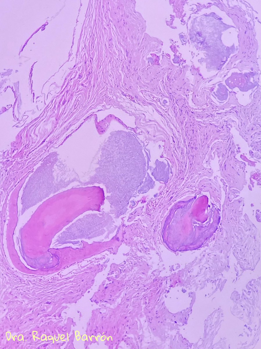 male, 14 years old. COMPOUND ODONTOMA. #PathTwitter #pathology #teeth