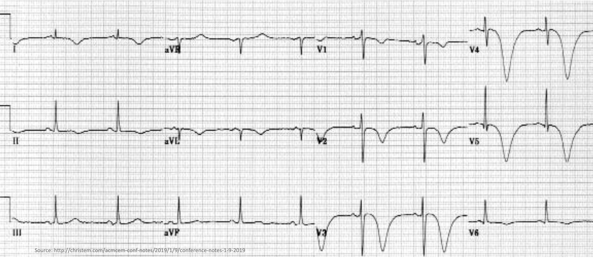 1/16 🤔Why does subarachnoid hemorrhage lead to deep/inverted 'cerebral T-waves'? This ECG finding is so dramatic. But as we will see, these patients often have normal hearts. Why does an issue in the brain manifest on a test of the heart?