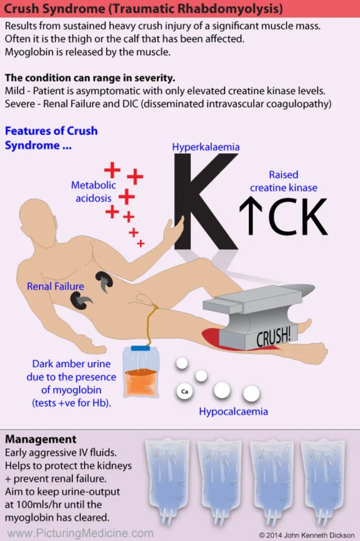 Manual Of Medicine on Twitter "Crush Syndrome (Traumatic