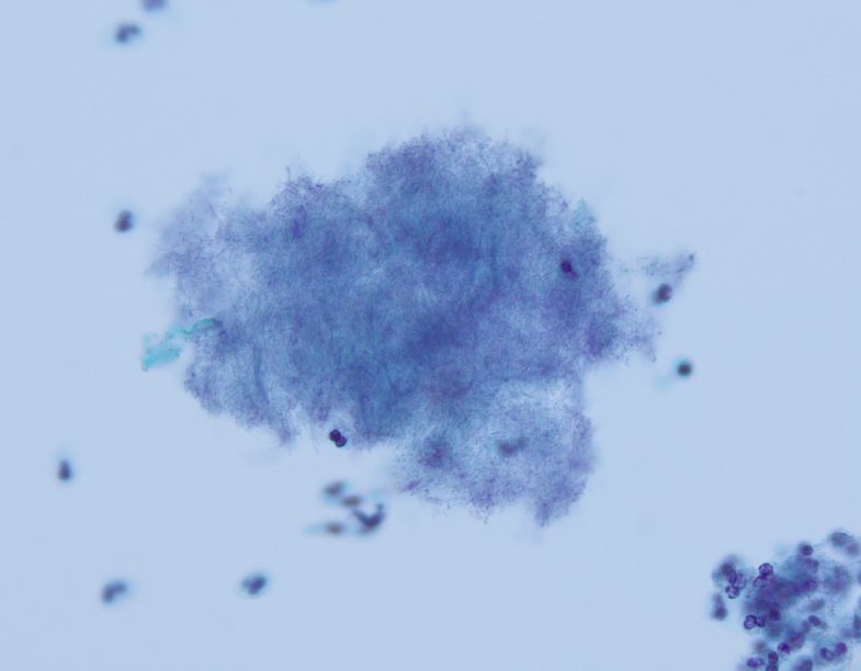 megothelioma's tweet photo. Really nice example of Actinomyces in this pap from a ThinPrep study set. This finding is associated with IUD use.
#Cytopath #basicpath #PathTwitter https://t.co/6Z9MBlAS3H