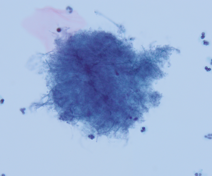 megothelioma's tweet photo. Really nice example of Actinomyces in this pap from a ThinPrep study set. This finding is associated with IUD use.
#Cytopath #basicpath #PathTwitter https://t.co/6Z9MBlAS3H