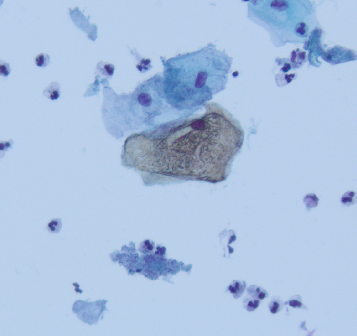 megothelioma's tweet photo. Another #basicpath finding from #cytopath. The brown crusty appearance of these squamous cells is referred to as cornflake artifact, caused by air drying of the smear.
#PathTwitter https://t.co/ZHNP7PqhrS