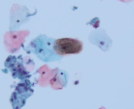 megothelioma's tweet photo. Another #basicpath finding from #cytopath. The brown crusty appearance of these squamous cells is referred to as cornflake artifact, caused by air drying of the smear.
#PathTwitter https://t.co/ZHNP7PqhrS
