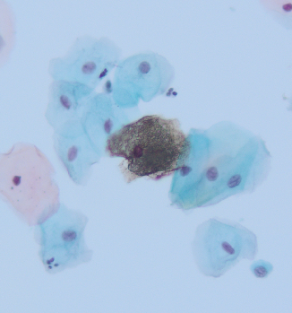 megothelioma's tweet photo. Another #basicpath finding from #cytopath. The brown crusty appearance of these squamous cells is referred to as cornflake artifact, caused by air drying of the smear.
#PathTwitter https://t.co/ZHNP7PqhrS