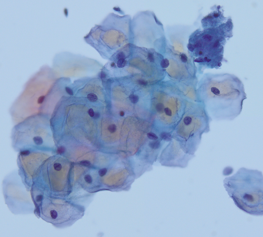 megothelioma's tweet photo. One of the challenges when you start learning cytopath (or any path) is recognizing normal variants. This brownish coloration in the squamous cells is just glycogen. "Cornflake" artifact can look similar.
#Basicpath #cytopath #PathTwitter https://t.co/SZRj7nYaoo