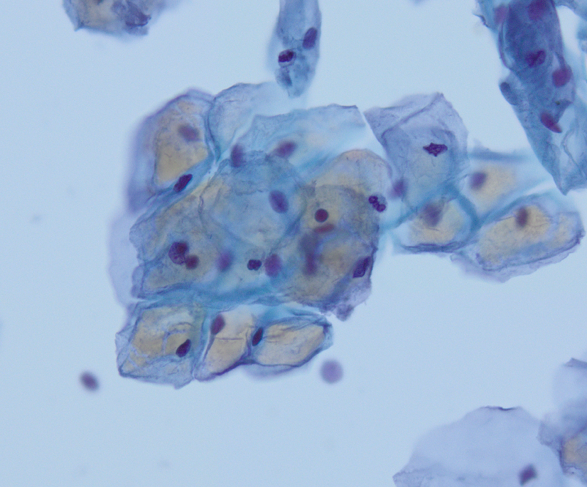 megothelioma's tweet photo. One of the challenges when you start learning cytopath (or any path) is recognizing normal variants. This brownish coloration in the squamous cells is just glycogen. "Cornflake" artifact can look similar.
#Basicpath #cytopath #PathTwitter https://t.co/SZRj7nYaoo