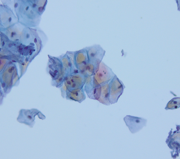 megothelioma's tweet photo. One of the challenges when you start learning cytopath (or any path) is recognizing normal variants. This brownish coloration in the squamous cells is just glycogen. "Cornflake" artifact can look similar.
#Basicpath #cytopath #PathTwitter https://t.co/SZRj7nYaoo