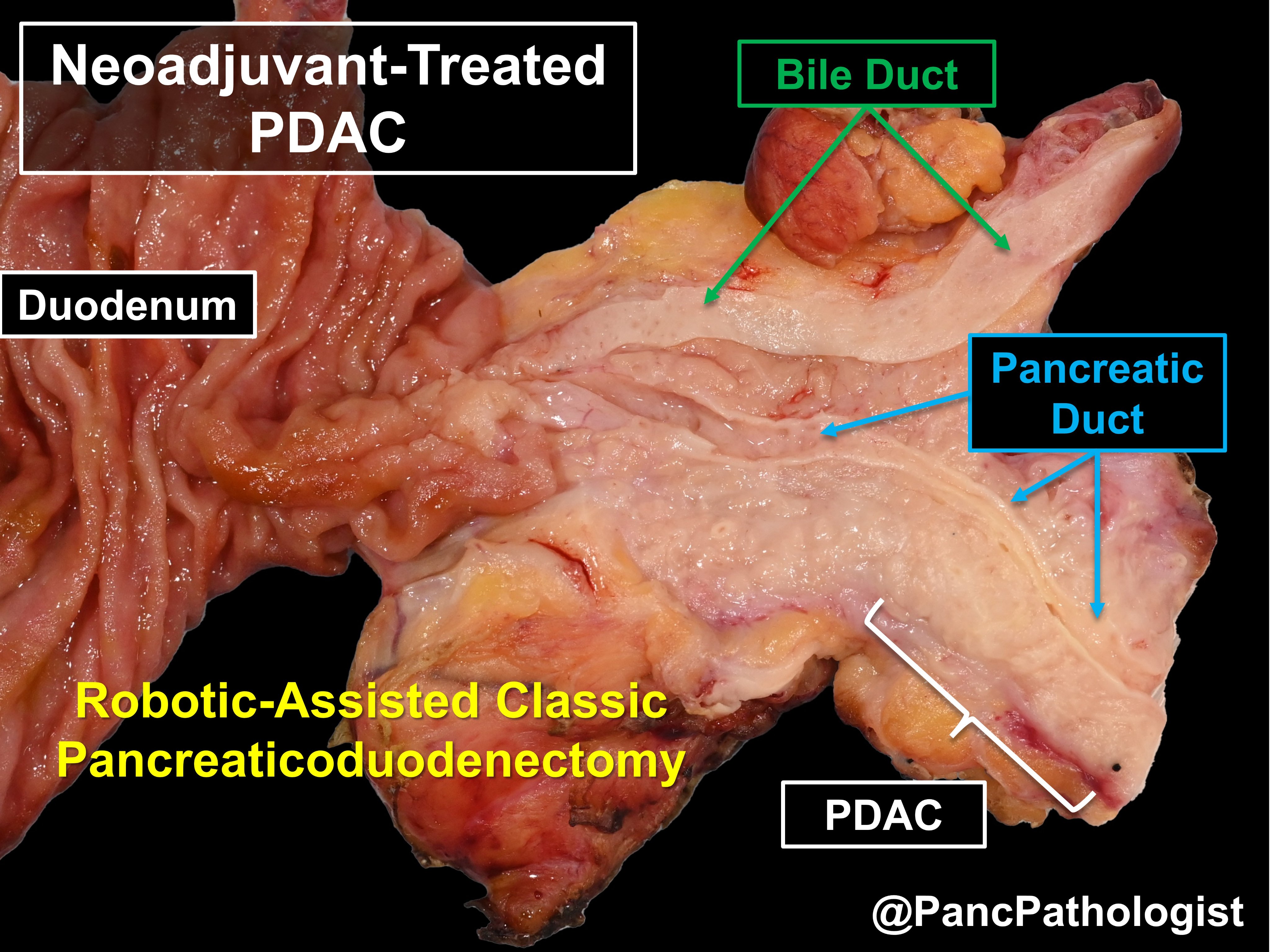 Aatur Singhi, MD PhD on X: Aatur Singhi, MD PhD on X: