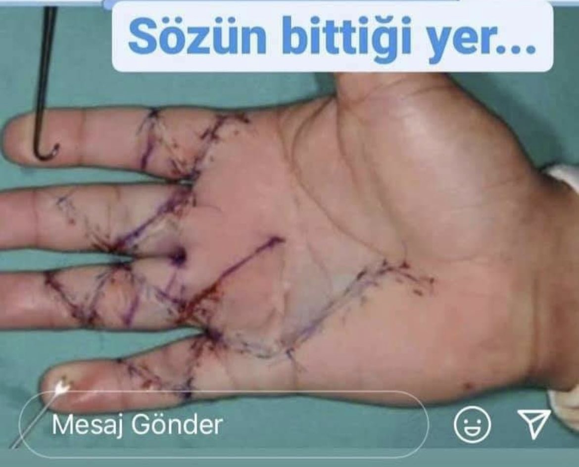 Bir cerrahın eli kesildi cerrahlık yapamayacak hale geldi.Bunu yapan ne kadar tazminat ödedi açıklarmısınız? Kendi hatalarınız eksikleriniz yüzünden hastanın hayatıyla gözü arasında karar vermek zorunda kalan doktora 4,5 milyon tazminat ödetip evine haciz getiriyorsunuz?