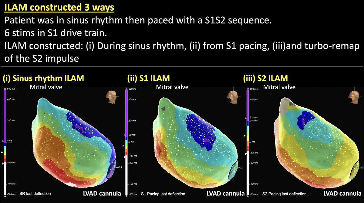 (1/3) I find it can be difficult to know exactly where to ablate from an ILAM. Points you in general direction but where exactly? This case was fun. Ischaemic CMP with LVAD. Constructed ILAM 3 ways. See how it relates to clinical VT in next post. #EPeeps