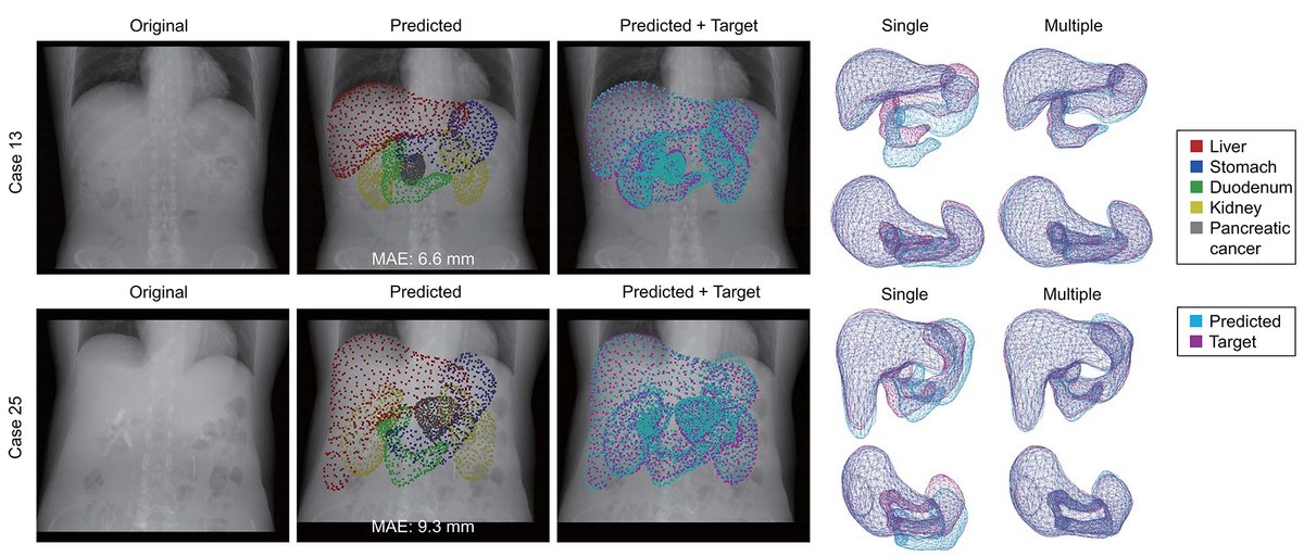 Early Access Paper Just Posted: Image-to-Graph Convolutional Network for 2D/3D Deformable Model Registration of Low-Contrast Organs. Read the paper: ieeexplore.ieee.org/document/98440….
