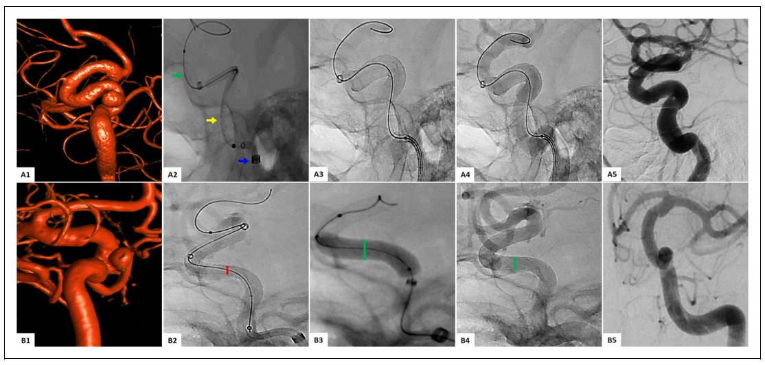 Juan Vivanco-Suarez (@jsvivanco1) on Twitter photo Flow diversion with the Surpass Streamline, is it safe and effective? Check out our US multicenter study. Big thanks to the collaborators. Grateful for the mentorship and opportunities by <a href="/CerebrovascLab/">Cerebrovascular & Neurointerventional Lab</a>! journals.sagepub.com/doi/10.1177/15… Flow diversion with the Surpass Streamline, is it safe and effective? Check out our US multicenter study. Big thanks to the collaborators. Grateful for the mentorship and opportunities by <a href="/CerebrovascLab/">Cerebrovascular & Neurointerventional Lab</a>! journals.sagepub.com/doi/10.1177/15…