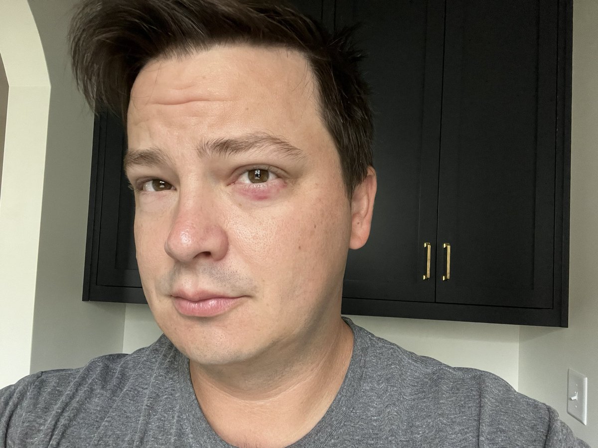 ledgerstatus's tweet photo. Gave myself a little shiner unloading stuff from my truck. https://t.co/0EecfA0nNP