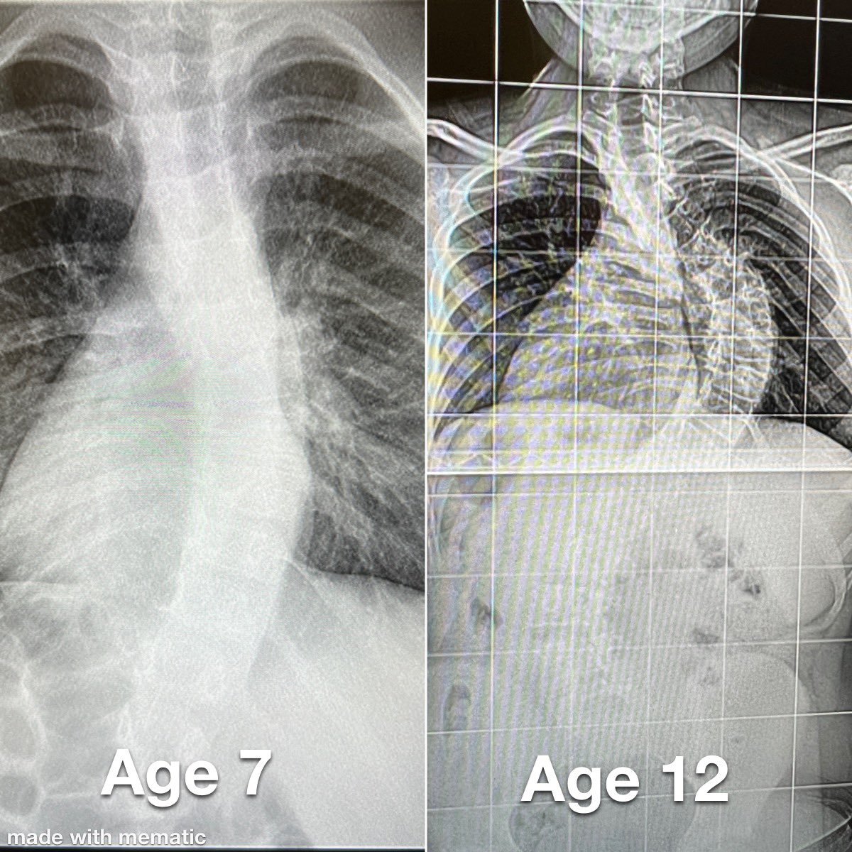 CraigLouer's tweet photo. PSA for parents and referring physicians:

Even small scoliosis in a growing child should be evaluated.  

Every clinic, I see patients who don’t need me.  But I am happy to see those patients so I can help the few that do need me.  

You’re not alone—let us help!
#scoliosis https://t.co/uaLNCe2CMR