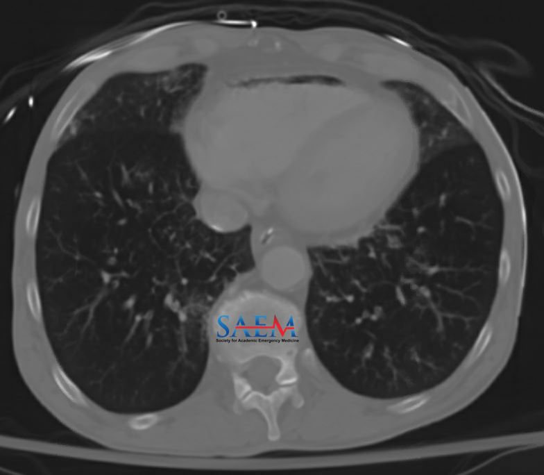 ALiEMteam's tweet photo. SAEM Clinical Image Series: Found Down

Are you familiar with the Durant maneuver? 

Maybe you should be... it can come in handy when you have a case like this one shared by Jonathan Trinh and Dr. Sternberg from @SouthEmergency.

https://t.co/nwvcb7qkSs

@SAEMonline https://t.co/5XnokwgsVM