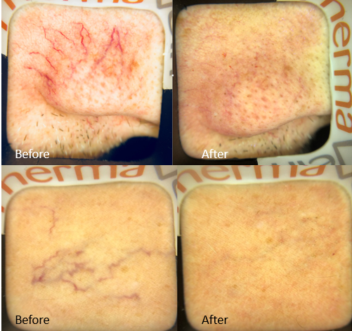 thermavein's tweet photo. Red veins. Thread veins. Spider veins. Telangiectasia. Whatever you call them, these pesky aesthetic veins can be safely, instantly and effectively treated with ThermaVein.
#threadveins #redveins #veins #aesthetics #beauty #spiderveins #threadveinremoval #facialbeauty #warts https://t.co/jGVhtfHnXe