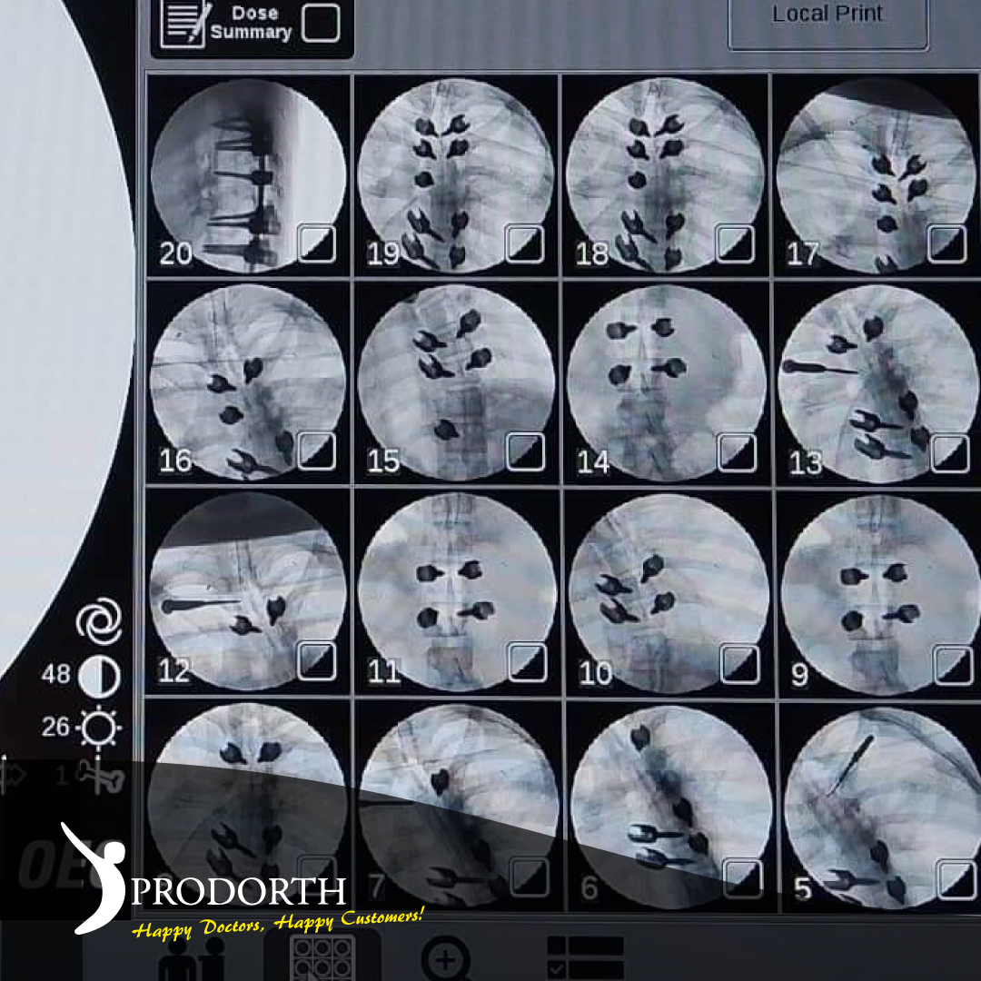 prodorth_spine's tweet photo. 🎯 Posterior Fixation Systems
🎯 Listhesis Pedicular Screws

PROXIPHIAS-L™️

📍 Bangladesh

https://t.co/xoMd5o4TE3

#prodorthspine #spinehealth #spinesurgery #spinedoctor #spinedevice #spineimplants #surgeryinstruments #spinesurgeryinstruments #orthopedicsurgery https://t.co/HE4rQcpoet